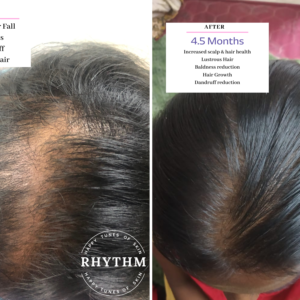 Hair Growth