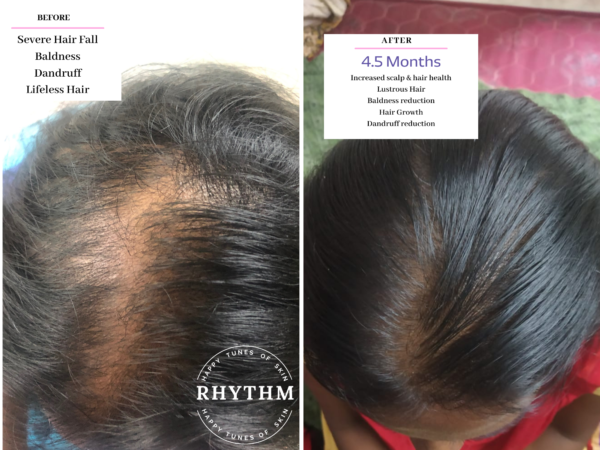 Hair Growth